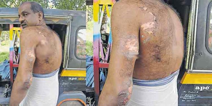 തലയണയുടെ അടിയിൽ വച്ച ഫോൺ കത്തി ; ഉറങ്ങിക്കിടന്ന ആൾക്കു പൊള്ളൽ തലയണയുടെ അടിയിൽ വച്ച ഫോൺ കത്തി ; ഉറങ്ങിക്കിടന്ന ആൾക്കു പൊള്ളൽ
