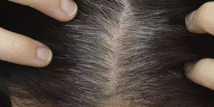 അകാലനര അകറ്റാൻ വീട്ടിലുണ്ട് പരിഹാരം അകാലനര അകറ്റാൻ വീട്ടിലുണ്ട് പരിഹാരം