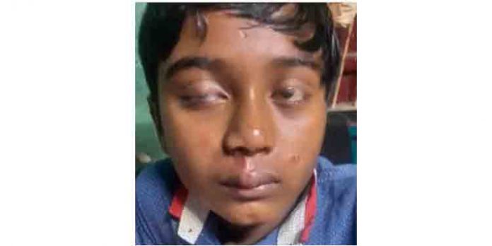 കുതിരയുടെ ആക്രമണത്തില് വിദ്യാര്ത്ഥിക്ക് ഗുരുതര പരിക്ക് ; വീട്ടില് പറഞ്ഞാല് കൊന്നുക്കളയുമെന്ന് കുതിരക്കാരന്റെ ഭീഷണി കുതിരയുടെ ആക്രമണത്തില് വിദ്യാര്ത്ഥിക്ക് ഗുരുതര പരിക്ക് ; വീട്ടില് പറഞ്ഞാല് കൊന്നുക്കളയുമെന്ന് കുതിരക്കാരന്റെ ഭീഷണി