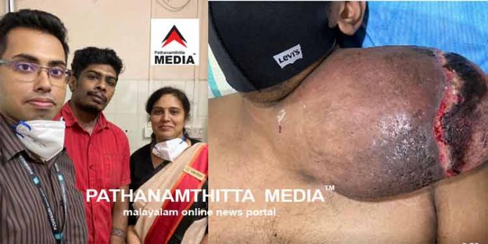 സങ്കീര്ണ്ണമായ ശസ്ത്രക്രിയയിലൂടെ പുഷ്പഗിരിയില് 24 കാരന് പുതുജീവന് സങ്കീര്ണ്ണമായ ശസ്ത്രക്രിയയിലൂടെ പുഷ്പഗിരിയില് 24 കാരന് പുതുജീവന്
