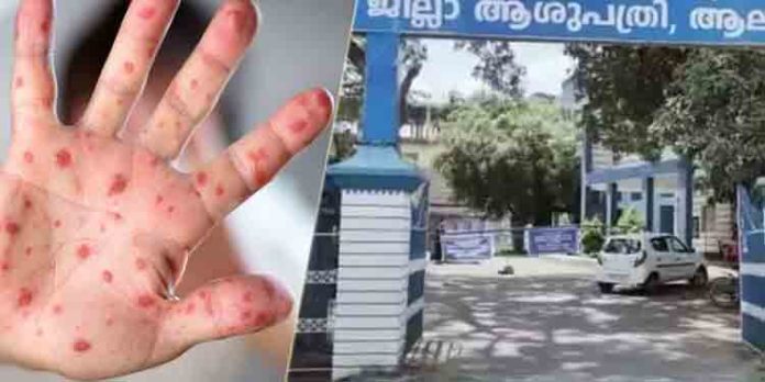 മങ്കിപോക്സ് ലക്ഷണങ്ങളെ തുടര്ന്ന് ചികിത്സയില് കഴിഞ്ഞിരുന്ന രോഗി ആശുപത്രിയില് നിന്നും ചാടിപ്പോയി മങ്കിപോക്സ് ലക്ഷണങ്ങളെ തുടര്ന്ന് ചികിത്സയില് കഴിഞ്ഞിരുന്ന രോഗി ആശുപത്രിയില് നിന്നും ചാടിപ്പോയി