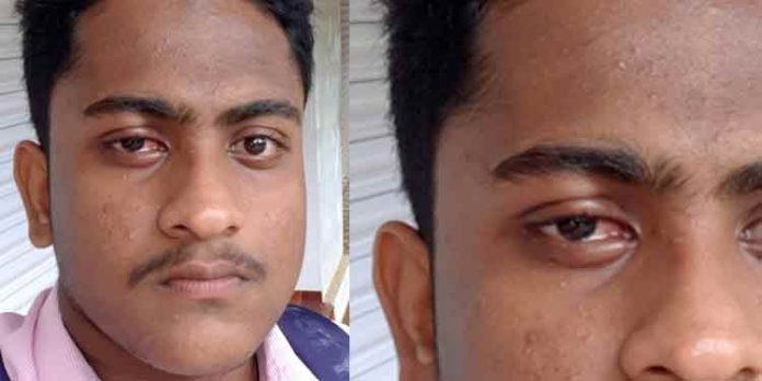തേക്ക് മരത്തിലെ പുഴു കണ്ണിൽ വീണ് വിദ്യാര്ഥിക്ക് പരിക്ക് തേക്ക് മരത്തിലെ പുഴു കണ്ണിൽ വീണ് വിദ്യാര്ഥിക്ക് പരിക്ക്