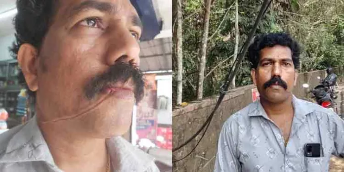 കൊച്ചിയില് കേബിള് കഴുത്തില് കുരുങ്ങി വീണ്ടും അപകടം കൊച്ചിയില് കേബിള് കഴുത്തില് കുരുങ്ങി വീണ്ടും അപകടം