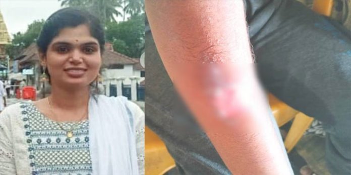 പൊള്ളലേറ്റ ഭാഗങ്ങളിൽ മുളക്പൊടി വിതറി ; വെള്ളായണി കാർഷിക കോളേജിൽവിദ്യാർത്ഥിനിക്കേറ്റത് ക്രൂര പീഡനം പൊള്ളലേറ്റ ഭാഗങ്ങളിൽ മുളക്പൊടി വിതറി ; വെള്ളായണി കാർഷിക കോളേജിൽവിദ്യാർത്ഥിനിക്കേറ്റത് ക്രൂര പീഡനം