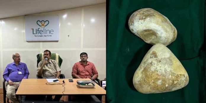 അറുപത്തഞ്ചുകാരനിൽ നിന്നും ശസ്ത്രക്രിയയിലൂടെ അര കിലോയോളം ഭാരമുള്ള കല്ല് നീക്കം ചെയ്തു അറുപത്തഞ്ചുകാരനിൽ നിന്നും ശസ്ത്രക്രിയയിലൂടെ അര കിലോയോളം ഭാരമുള്ള കല്ല് നീക്കം ചെയ്തു