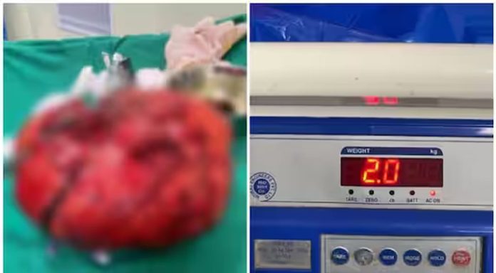 60 വയസുകാരന്റെ കഴുത്തിൽ നിന്ന് രണ്ട് കിലോഗ്രാം ഭാരം വരുന്ന മുഴ ശസ്ത്രക്രിയയിലൂടെ നീക്കം ചെയ്തു 60 വയസുകാരന്റെ കഴുത്തിൽ നിന്ന് രണ്ട് കിലോഗ്രാം ഭാരം വരുന്ന മുഴ ശസ്ത്രക്രിയയിലൂടെ നീക്കം ചെയ്തു