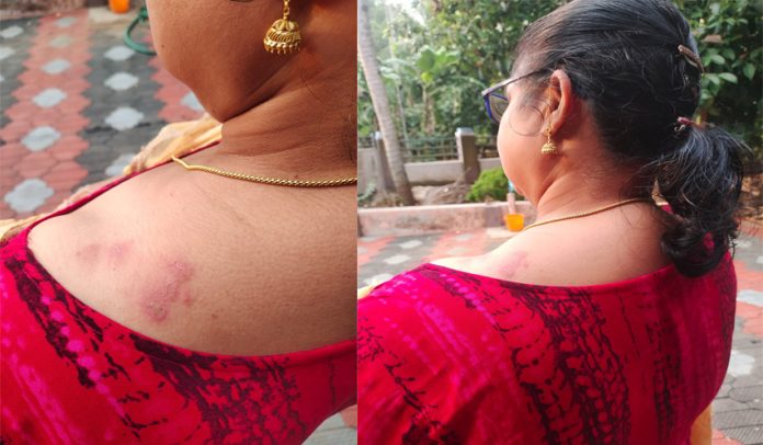 കോന്നിയില് കനത്ത ചൂടില് വീട്ടമ്മയ്ക്ക് സൂര്യാഘാതമേറ്റു കോന്നിയില് കനത്ത ചൂടില് വീട്ടമ്മയ്ക്ക് സൂര്യാഘാതമേറ്റു