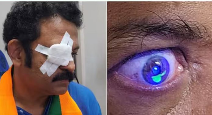 തെരഞ്ഞെടുപ്പ് പ്രചാരണത്തിനിടെ എന്ഡിഎ സ്ഥാനാര്ത്ഥി ജി കൃഷ്ണകുമാറിന് പരുക്ക് തെരഞ്ഞെടുപ്പ് പ്രചാരണത്തിനിടെ എന്ഡിഎ സ്ഥാനാര്ത്ഥി ജി കൃഷ്ണകുമാറിന് പരുക്ക്