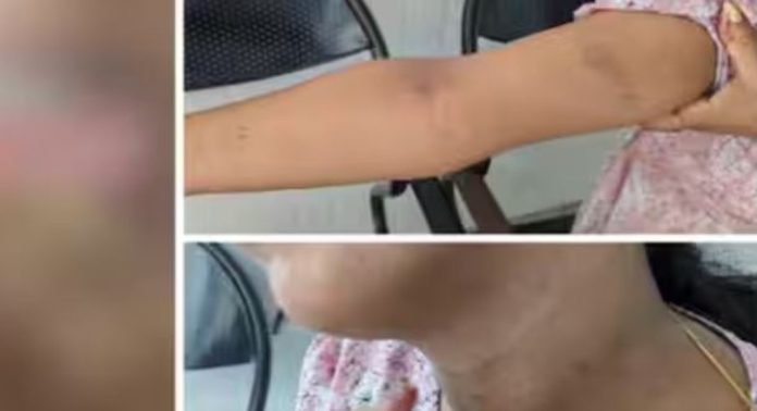 നവവരന് എട്ടിന്റെ പണി ; നവവധുവിനെ ഭർത്താവ് ക്രൂരമായി മർദ്ദിച്ച കേസ്, മുഖ്യമന്ത്രിക്ക് പരാതി നൽകാൻ ഒരുങ്ങി കുടുംബം നവവരന് എട്ടിന്റെ പണി ; നവവധുവിനെ ഭർത്താവ് ക്രൂരമായി മർദ്ദിച്ച കേസ്, മുഖ്യമന്ത്രിക്ക് പരാതി നൽകാൻ ഒരുങ്ങി കുടുംബം
