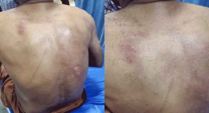 മിന്നലേറ്റ് അഞ്ചുപേർക്ക് പരിക്ക് , രണ്ടുപേർക്ക് ഗുരുതരം മിന്നലേറ്റ് അഞ്ചുപേർക്ക് പരിക്ക് , രണ്ടുപേർക്ക് ഗുരുതരം