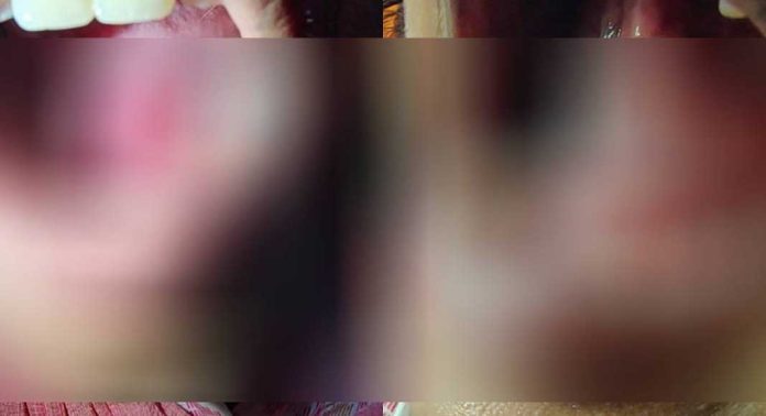 പാലക്കാട് ഡെന്റൽ ക്ലിനിക്കിൽ ചികിത്സക്കിടെ യുവതിയുടെ നാക്കിൽ ഡ്രില്ലർ തുളച്ചു കയറി പാലക്കാട് ഡെന്റൽ ക്ലിനിക്കിൽ ചികിത്സക്കിടെ യുവതിയുടെ നാക്കിൽ ഡ്രില്ലർ തുളച്ചു കയറി