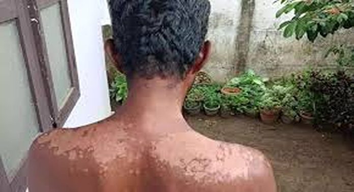 ആലുവ കടുങ്ങല്ലൂരിൽ മത്സ്യ വിൽപ്പനക്കാരന് സൂര്യാതാപമേറ്റു ആലുവ കടുങ്ങല്ലൂരിൽ മത്സ്യ വിൽപ്പനക്കാരന് സൂര്യാതാപമേറ്റു