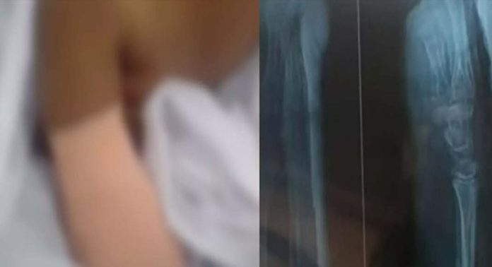 വലത് കൈ മുറിച്ചു മാറ്റേണ്ടി വന്ന പല്ലശനയിലെ കുട്ടിക്ക് ഇന്ന് ശസ്ത്രക്രി വലത് കൈ മുറിച്ചു മാറ്റേണ്ടി വന്ന പല്ലശനയിലെ കുട്ടിക്ക് ഇന്ന് ശസ്ത്രക്രി