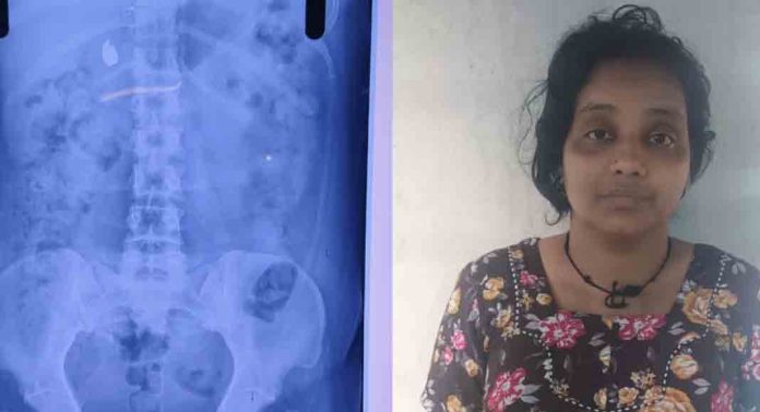 മോഷ്ടിച്ച മാല യുവതി വിഴുങ്ങി ; വീണ്ടെടുക്കാൻ കാത്തിരുന്ന് പോലീസ് മോഷ്ടിച്ച മാല യുവതി വിഴുങ്ങി ; വീണ്ടെടുക്കാൻ കാത്തിരുന്ന് പോലീസ്