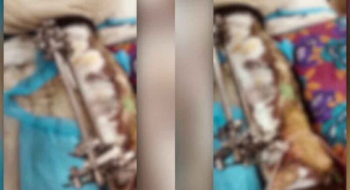 തിരുവനന്തപുരം മെഡിക്കൽ കോളേജിൽ സർജറി കഴിഞ്ഞ് ഐസിയുവിൽ നിന്ന് വാര്ഡിലാക്കിയ രോഗിയുടെ കാൽ പുഴുവരിച്ച നിലയിൽ ; ബന്ധുക്കളുടെ പ്രതിഷേധം തിരുവനന്തപുരം മെഡിക്കൽ കോളേജിൽ സർജറി കഴിഞ്ഞ് ഐസിയുവിൽ നിന്ന് വാര്ഡിലാക്കിയ രോഗിയുടെ കാൽ പുഴുവരിച്ച നിലയിൽ ; ബന്ധുക്കളുടെ പ്രതിഷേധം